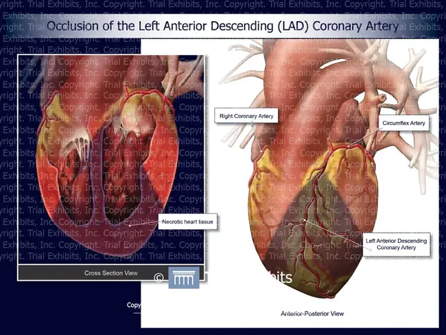 Anterior Descending Artery : 前降支