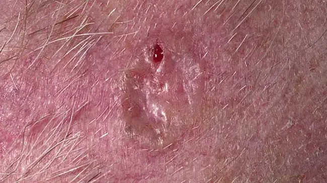 Basal Cell Carcinoma : 基底细胞癌