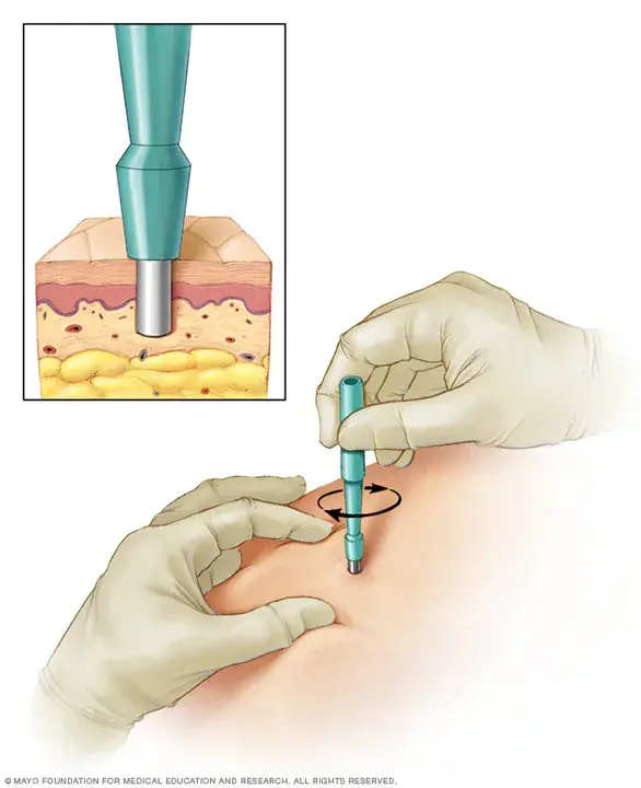 Biopsy : 活检