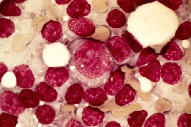 Chronic Lymphocytic Leukaemia : 慢性淋巴细胞白血病