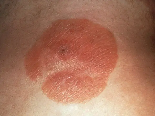 Cutaneous T Cell Lymphoma : 皮肤T细胞淋巴瘤