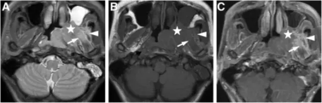 Familial Medullary Thyroid Carcinoma : 家族性甲状腺髓样癌