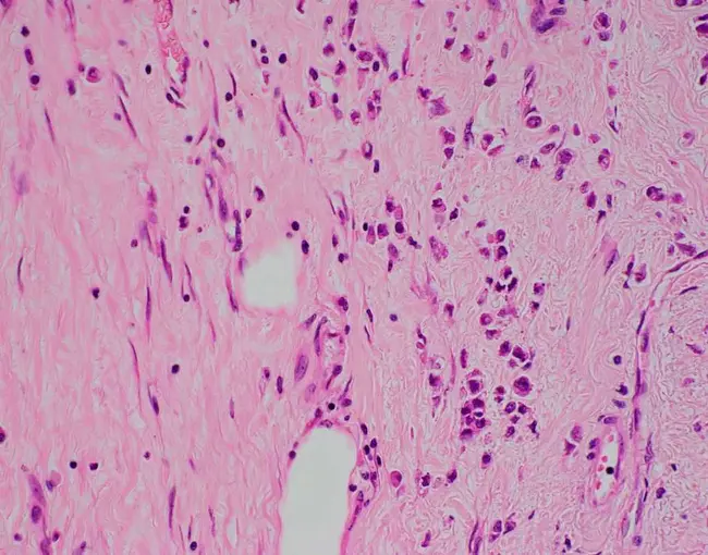 Lobular Carcinoma In-Situ : 小叶原位癌