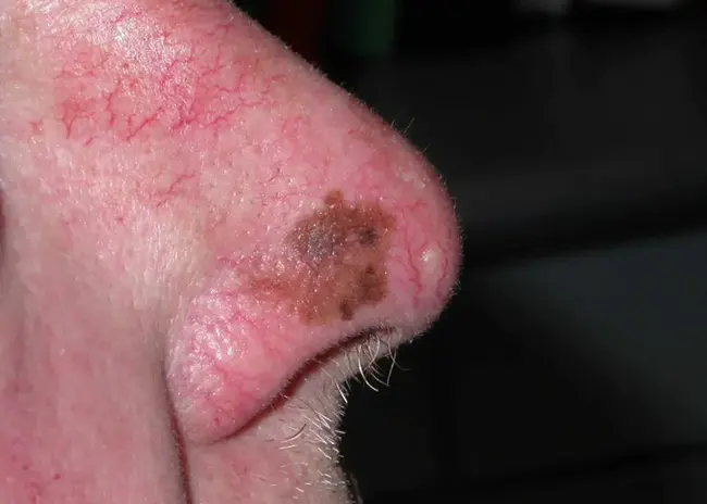 Lentigo Maligna Melanoma : 黑色素瘤