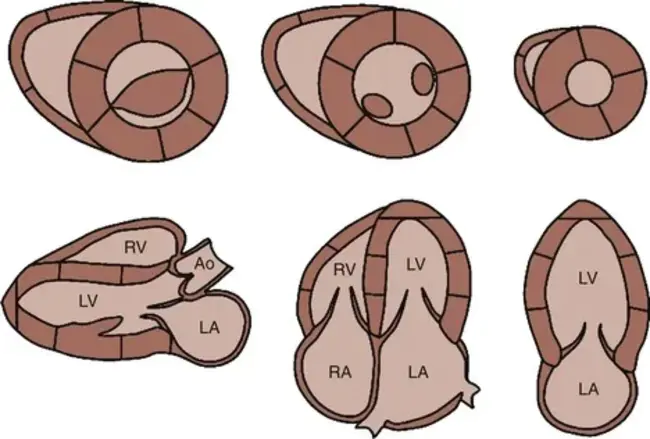 Left Ventricular Shortening Fraction : 左心室缩短率