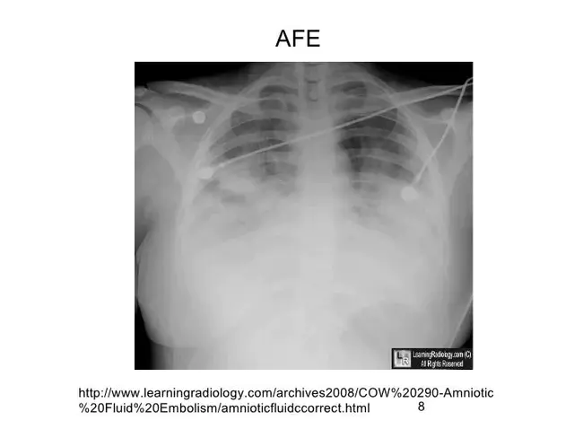 Amniotic Fluid : 羊水