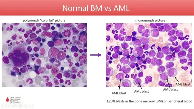 Acute GlomeruloNephritis : 急性肾小球肾炎