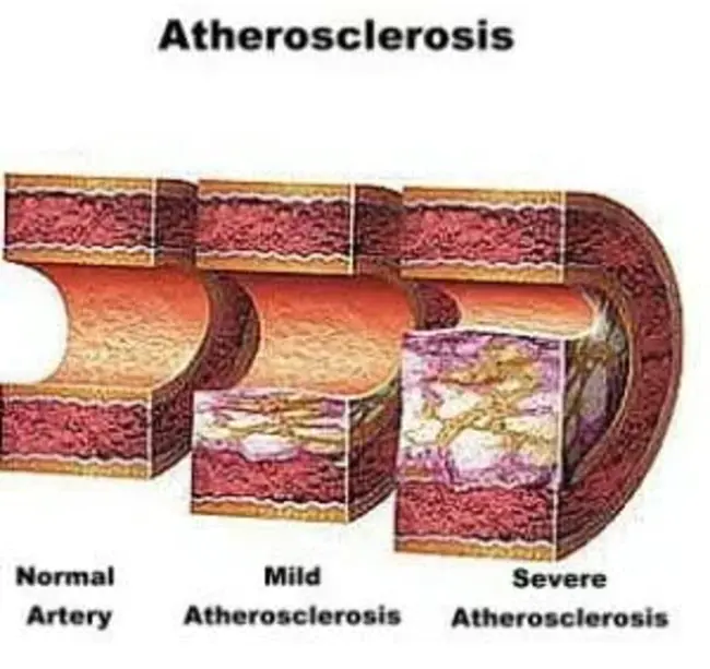 Arteriosclerotic Heart Disease : 动脉硬化性心脏病