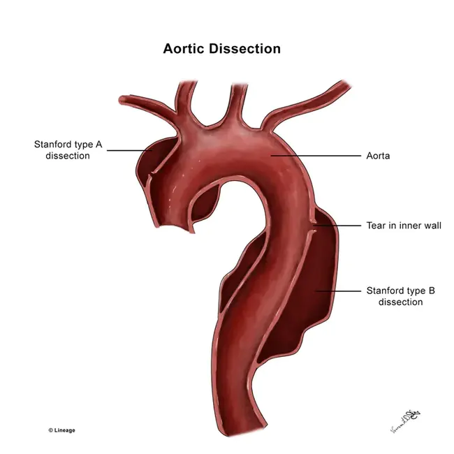 Aortic Insufficiency : 主动脉瓣关闭不全