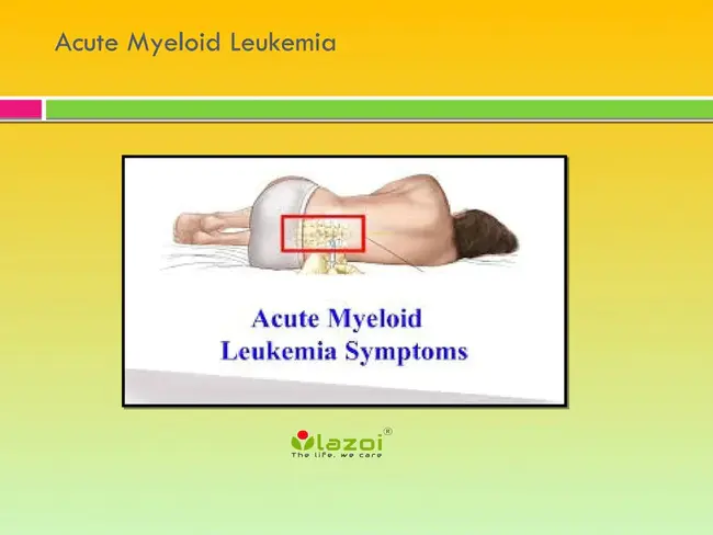 Acute Lymphoblastic Leukemia : 急性淋巴细胞白血病