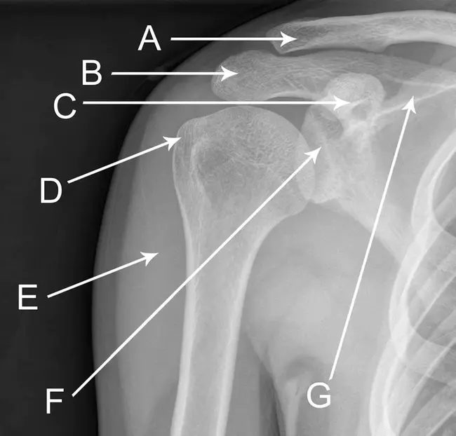 AnteroPosterior : 前后位的