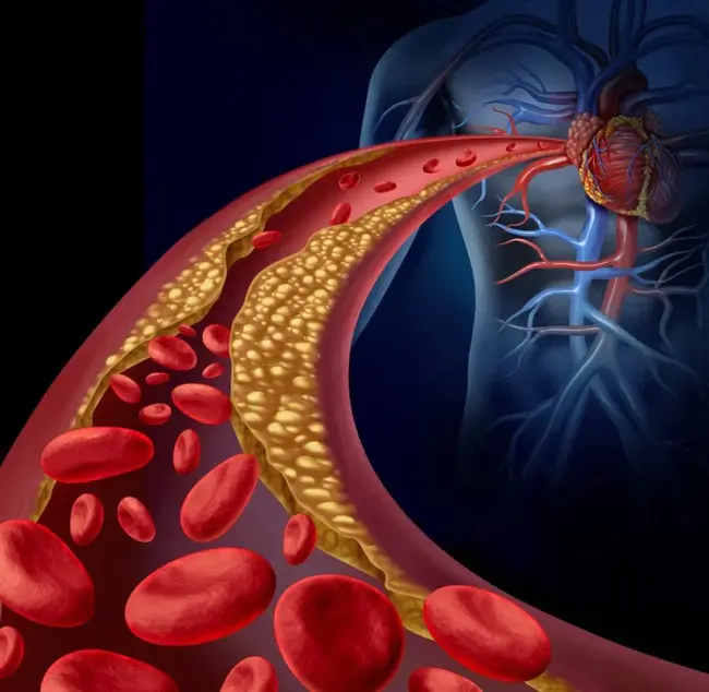 ArterioSclerosis : 动脉硬化