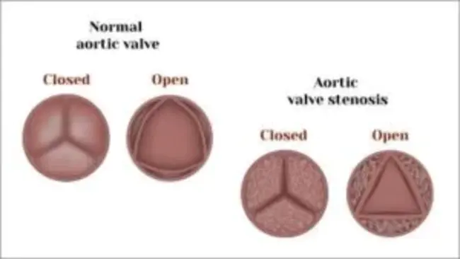 Aortic Stenosis : 主动脉狭窄