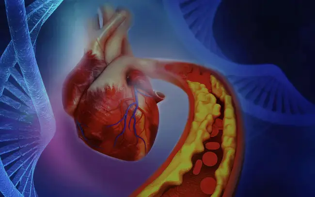 Atherosclerotic Coronary Artery Disease : 动脉粥样硬化性冠状动脉疾病