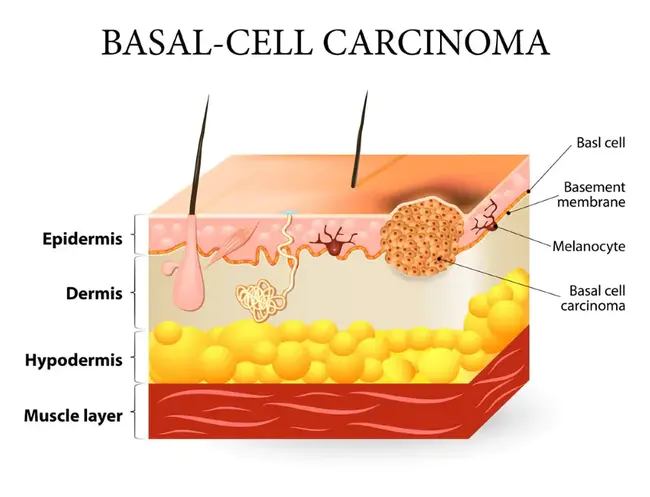 Basal : 基底的