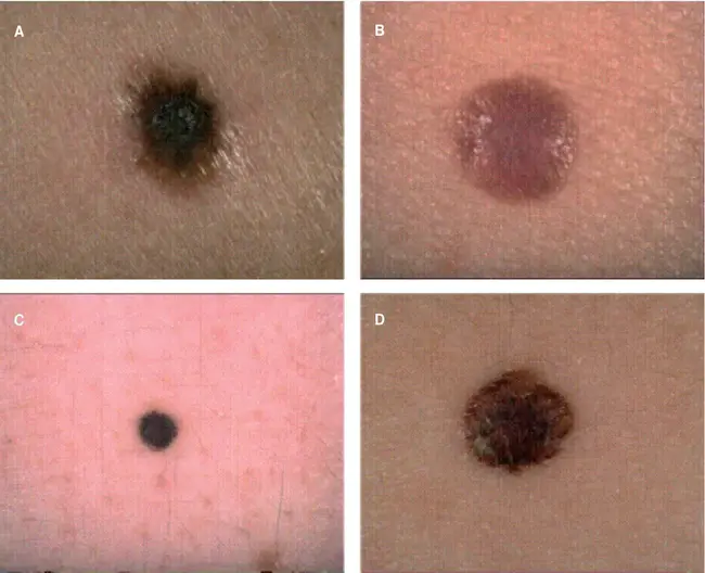 Nodular Melanoma : 结节性黑色素瘤