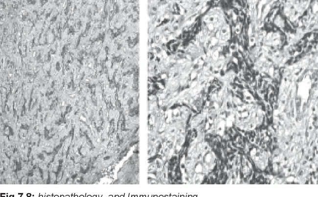 Primitive NeuroEctodermal Tumor : 原发性神经外胚层肿瘤