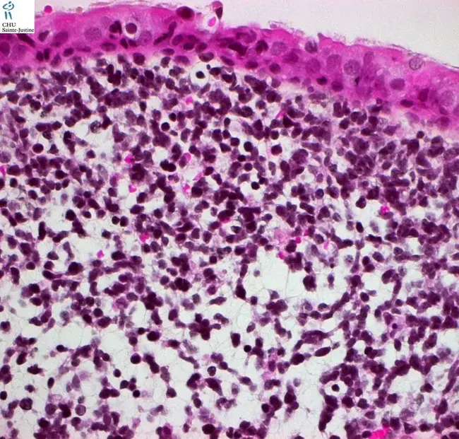 RhabdoMyoSarcoma : 横纹肌肉瘤