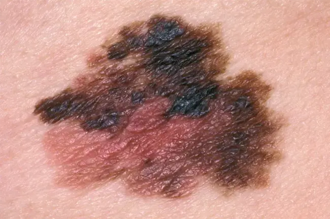 Superficial Spreading Melanoma : 浅表性蔓延性黑色素瘤