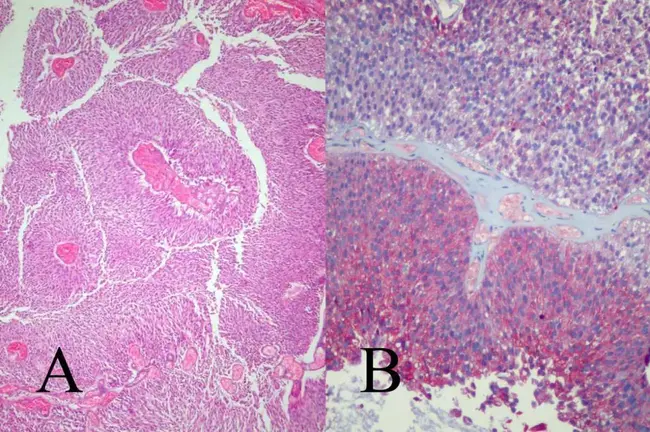 Transitional Cell Carcinoma : 移行细胞癌