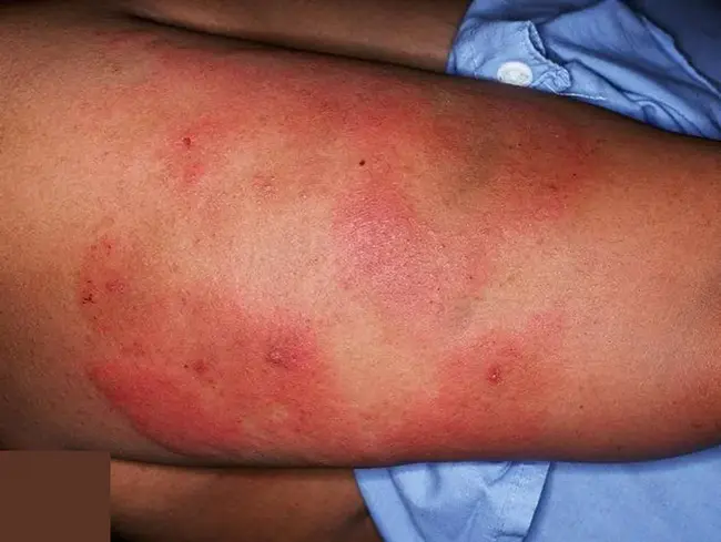 ThromboCytoPenia : 血小板减少