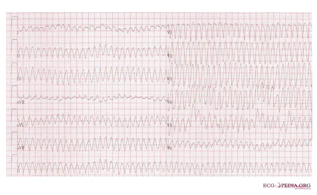 Ventricular Ejection Fraction : 心室射血分数