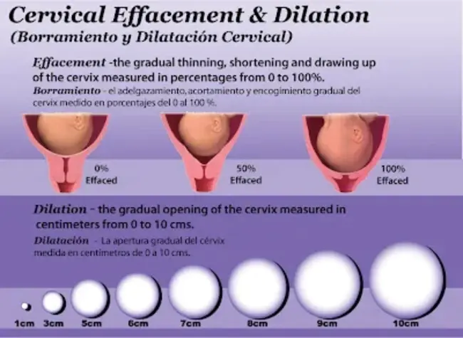 Dilation & Curettage : 扩张