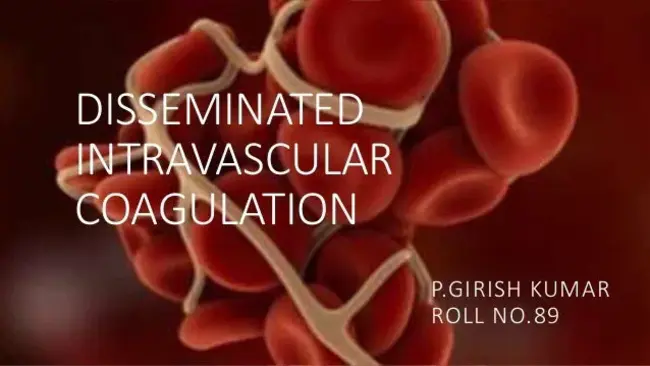 Disseminated intravascular coagulation : 弥散性血管内凝血