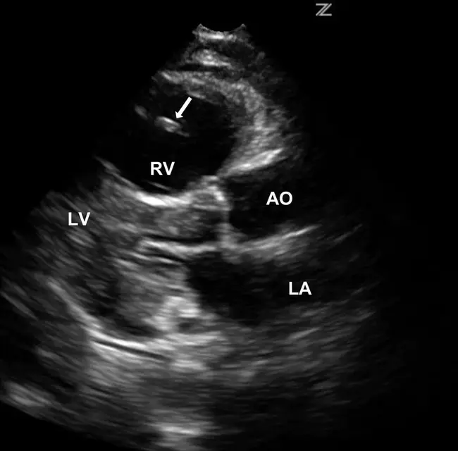 Echocardiography : 超声心动图