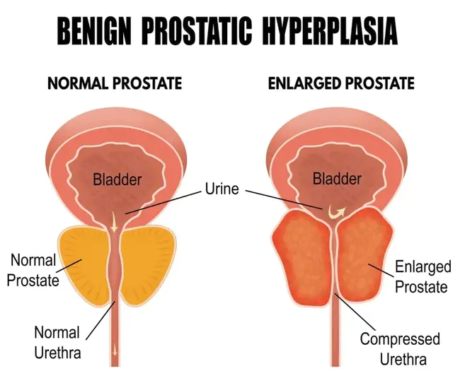 Prostatic Acid Phosphatase : 前列腺酸磷酸酶