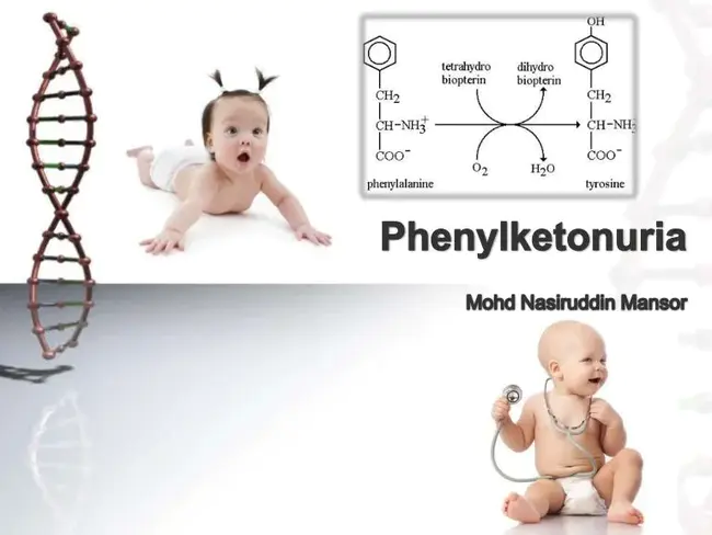 PhenylKetonUria : 苯丙酮尿症