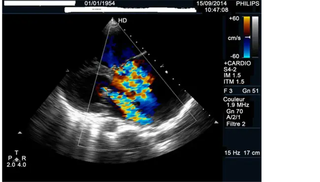 Trans-Thoracic Echocardiography : 经胸超声心动图