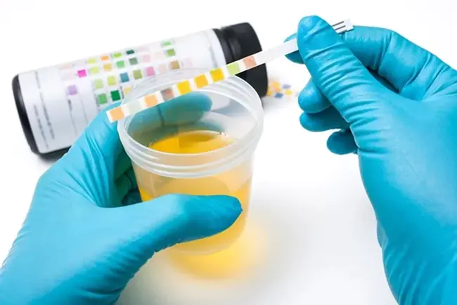 UrinAlysis : 尿液分析