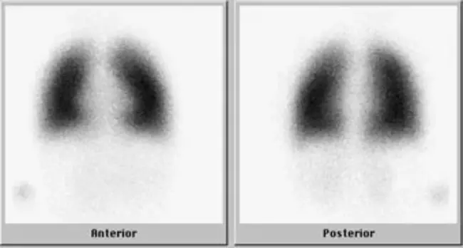 Ventilation/Perfusion Scanning : 通气/灌注扫描