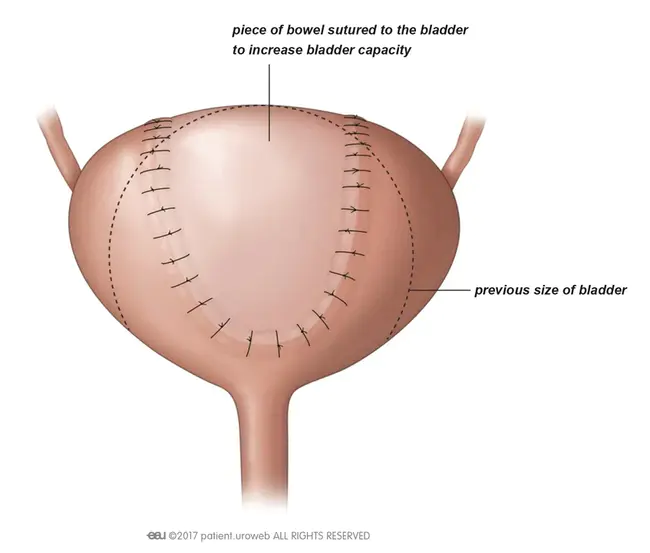 Bladder Neck Obstruction : 膀胱颈梗阻