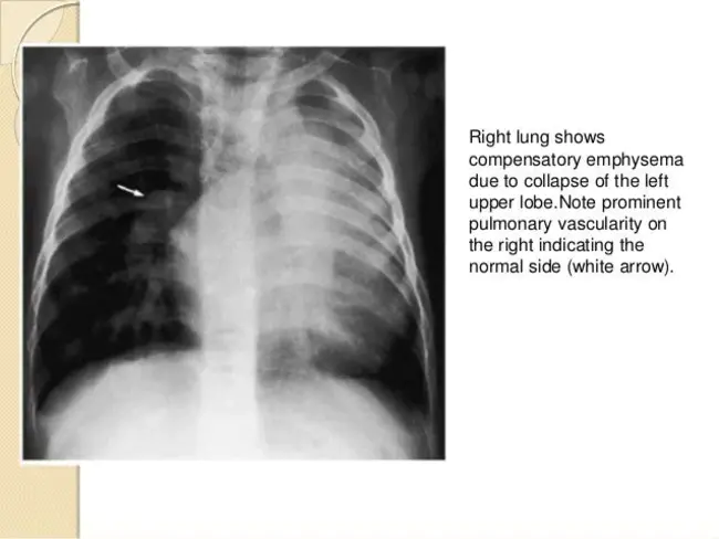 Bilateral Otitis Externa : 双侧外耳炎