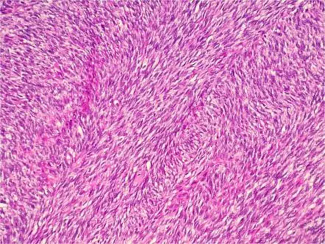 Bilateral Otitis Media : 双侧中耳炎