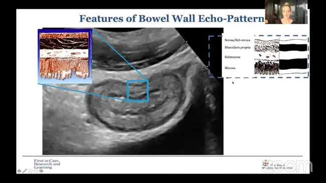 Bowel Sounds : 肠鸣音