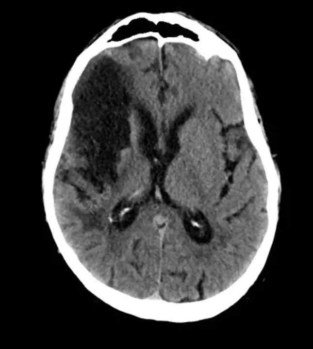 Chronic Airway Obstruction : 慢性气道阻塞