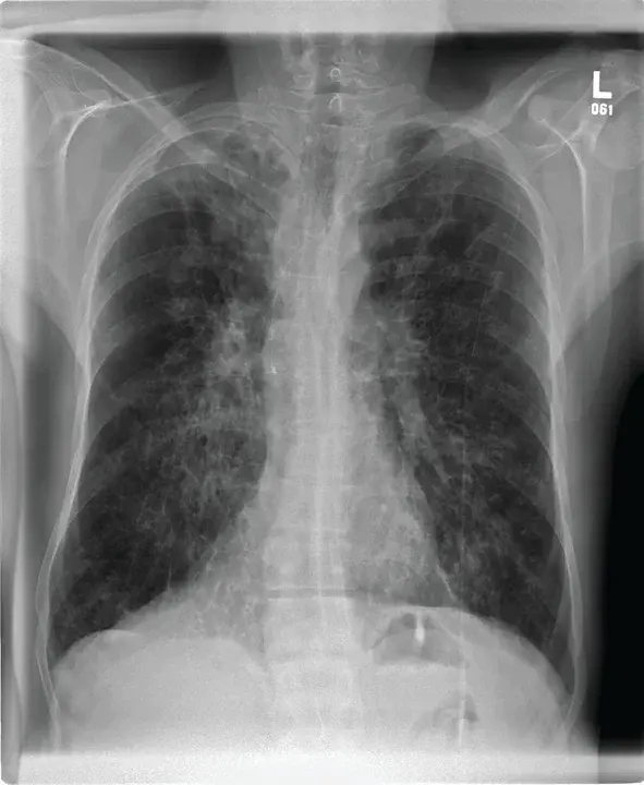 Cystic Fibrosis : 囊性纤维化