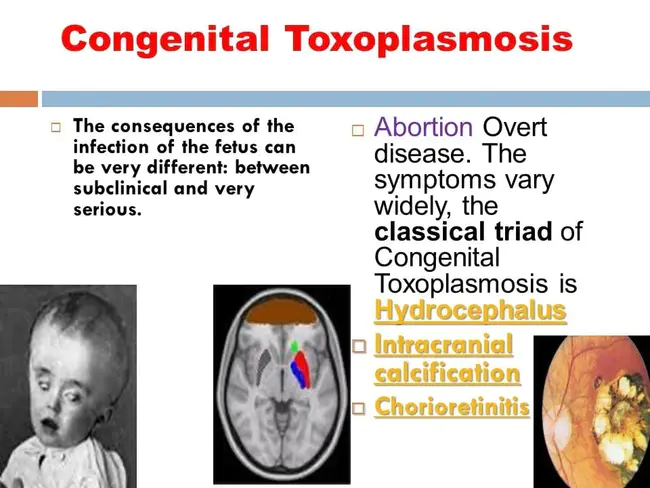 Congenital Hip Dislocation : 先天性髋关节脱位