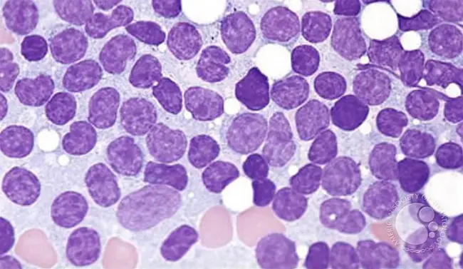 Chronic Lymphocytic Leukemia : 慢性淋巴细胞白血病