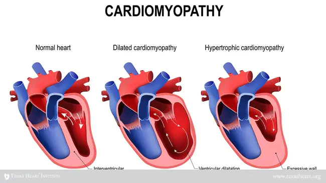 Myocardiopathy of Unknown Origin : 不明原因的心肌病变