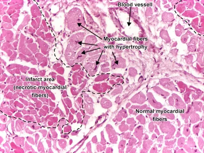 Myocardial Oxygen Consumption : 心肌耗氧量