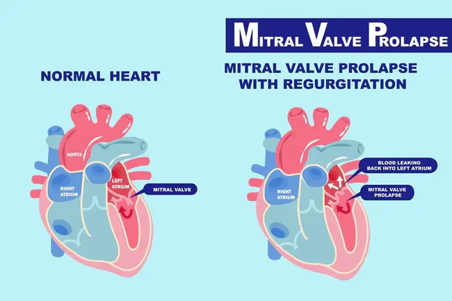 Mitral Valve Prolapse : 二尖瓣脱垂