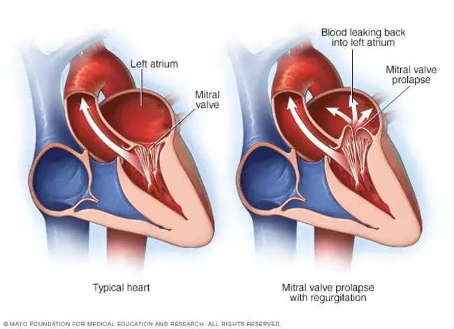 Mitral Valve Replacement : 二尖瓣置换术