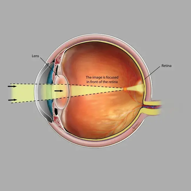 Myopia : 近视