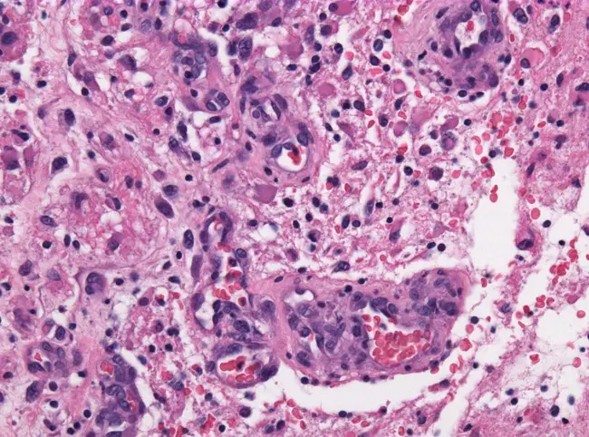 NeuroPathology : 神经病理学