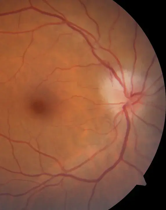 Optic Neuritis : 视神经炎