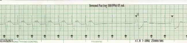 Pacing Cardioverter/ Defibrillator : 起搏复律器/除颤器